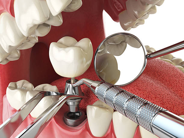 Best Emergency Dental Care for Broken or Chipped Teeth in Terre Haute, IN